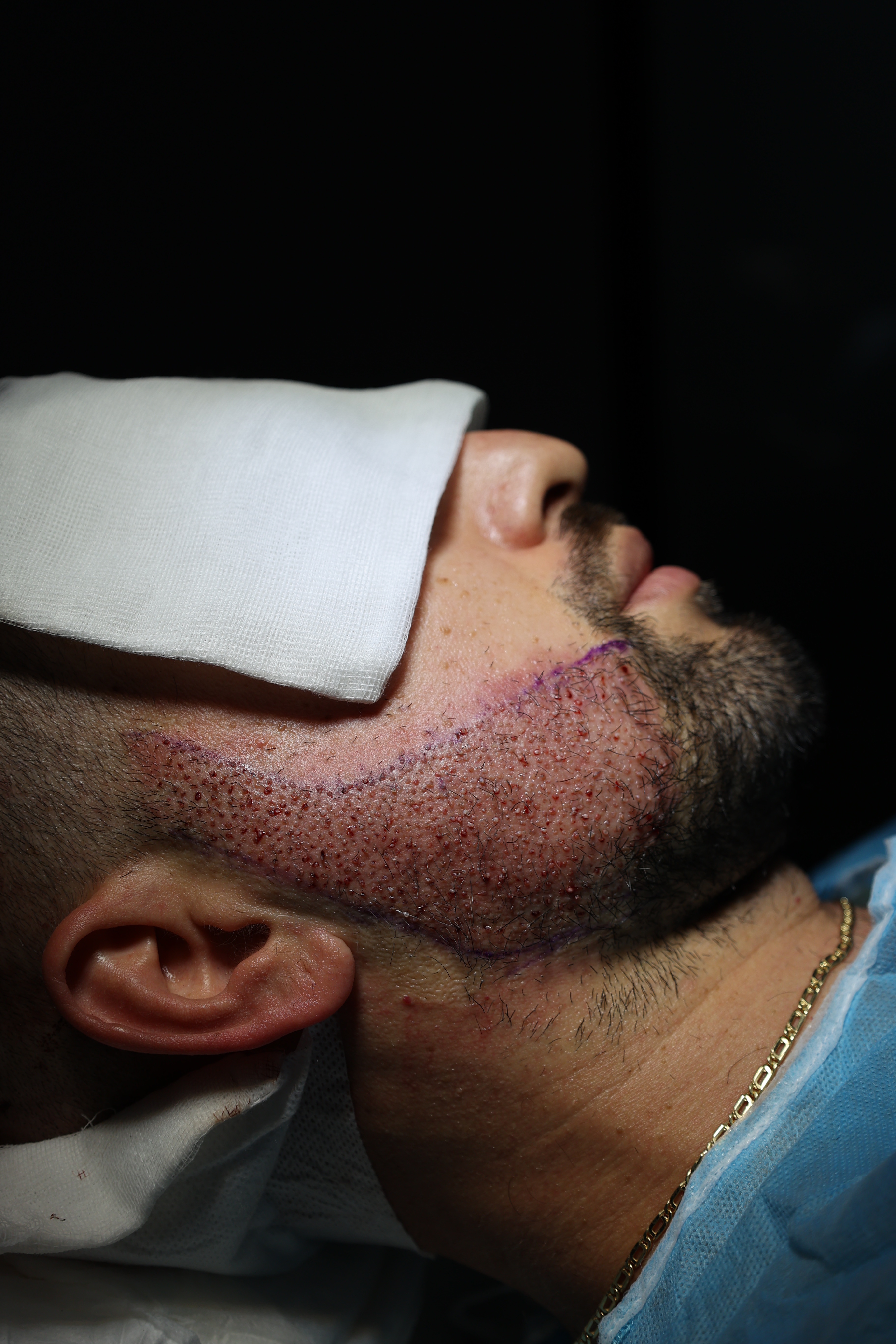 Kujdesi pas transplantit të mjekrës